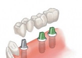 Клиника  потери зубов