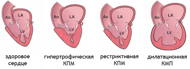 Аномалии отхождения коронарных артерий10