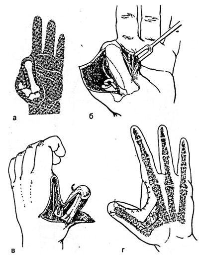 Пересадка пальцев с ног на руку10