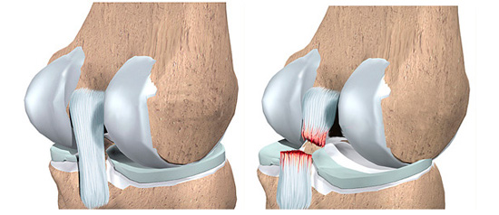 Повреждение мениска коленного сустава10