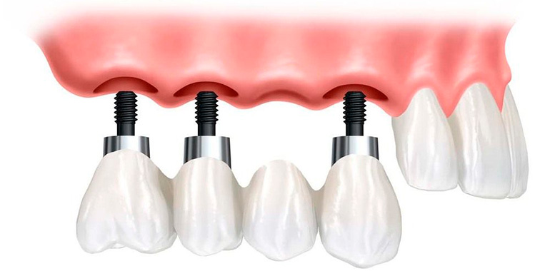 Перекрывающие зубные протезы10