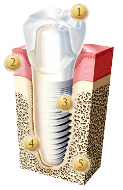 Имплантат верхнего  зуба10