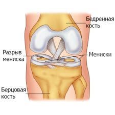 Перелом костей коленного сустава11