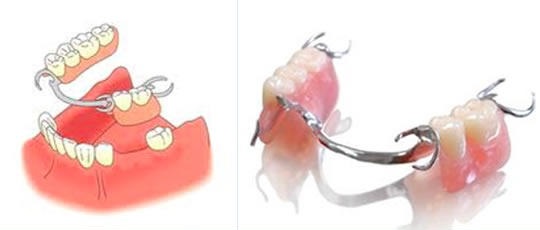 Имплантаты, соединенные с зубами11