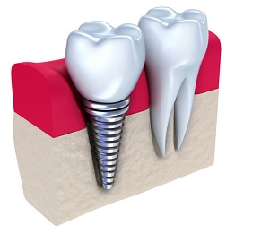 Перекрывающие зубные протезы11