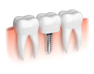 Имплантация одиночных зубов7
