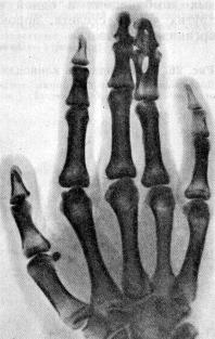 Пересадка пальцев с ног на руку12
