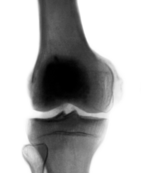 Анатомия коленного сустава12
