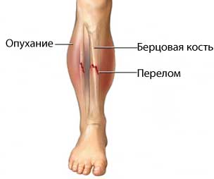 Перелом костей коленного сустава12