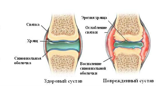 Повреждения связок коленного сустава12
