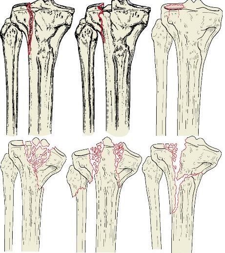 Перелом костей коленного сустава15