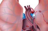 Варианты хирургического лечения легочной артерии