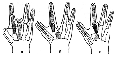 Первый палец кисти15