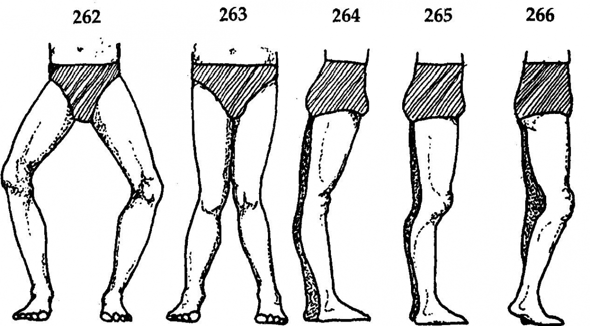 Повреждения связок коленного сустава15