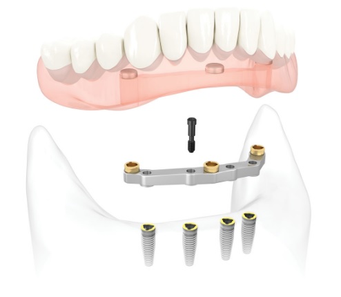 Перекрывающие зубные протезы15