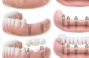Восстановление всех зубов верхней челюсти