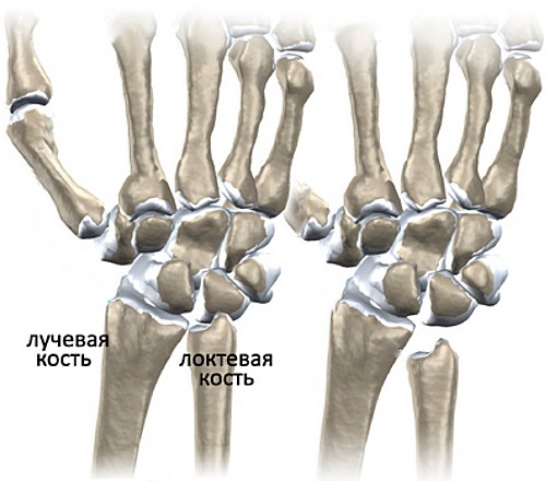 Пересадка пальцев с ног на руку16