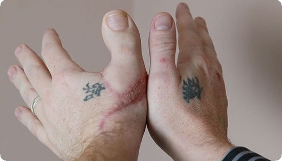 Пересадка пальцев с ног на руку