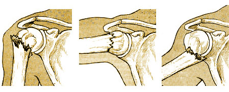 Диафизарные переломы плечевой кости1