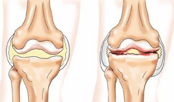 Повреждение мениска коленного сустава1