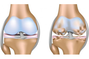 Гонартроз коленного сустава1