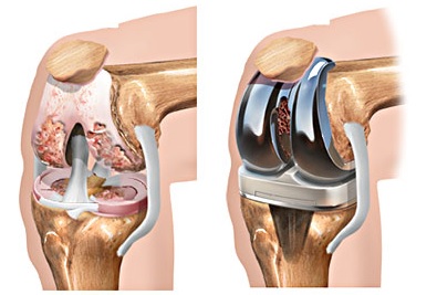 Эндопротезирование коленного сустава1