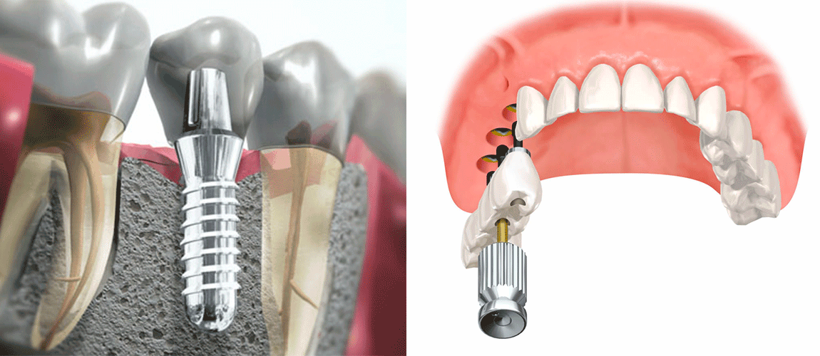 Выбор материала для зубного имплантата1