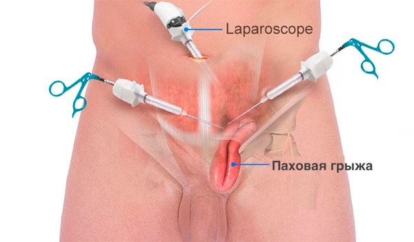 Эндоскопипческая операция по удалению грыжи1
