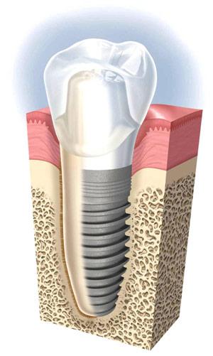 Имплантаты, соединенные с зубами1