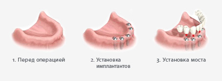 Челюсть с полным отсутствием зубов1