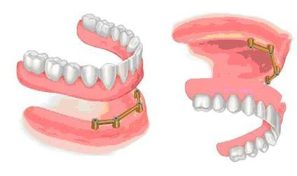 Перекрывающие зубные протезы1
