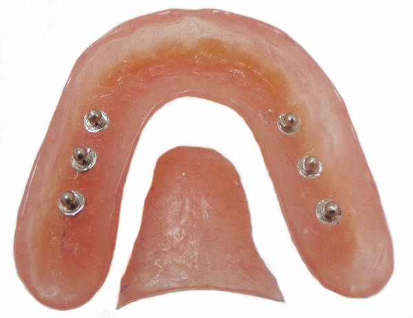 Имплантация верхней челюсти при частичном отсутствии зубов1