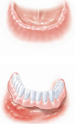 Восстановление всех зубов верхней челюсти1