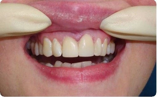 Особенности восстановления передних зубов1