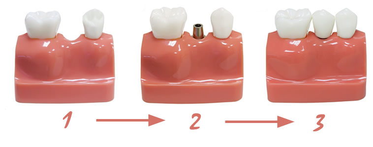 Замещение одиночных зубов1