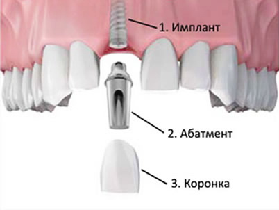Имплантат верхнего  зуба1