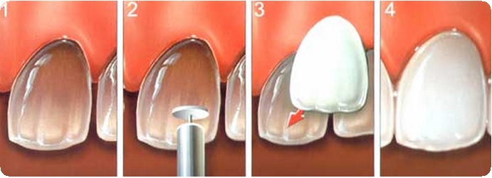 Восстановление переднего зуба1