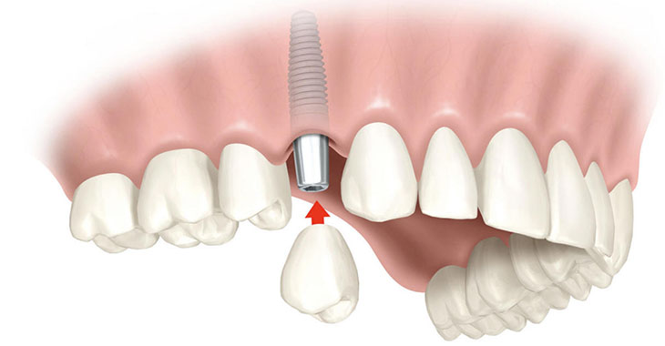Установка имплантата сразу после удаления зуба1