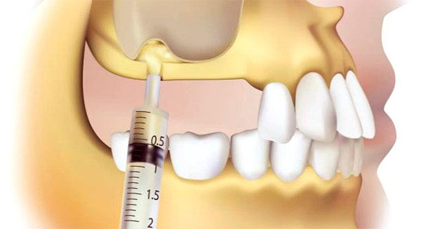 Осложнения при имплантации зубов верхней челюсти1