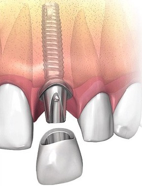 Установка несъемного зубного протеза1