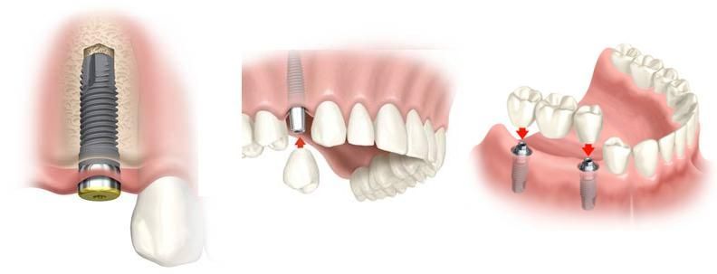 Пассивные зубные реставрации1