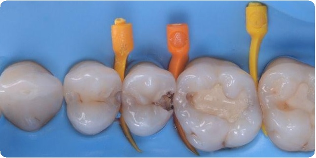 Протокол реставрации зубов1