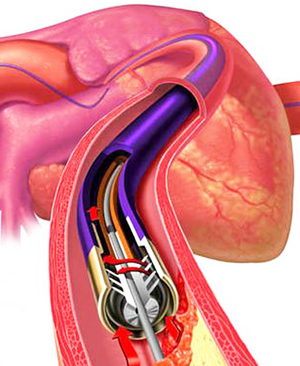Диагностическая катетеризация сердца1