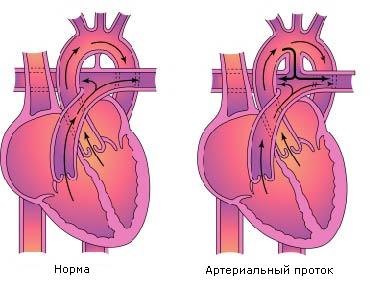 Открытый артериальный проток1