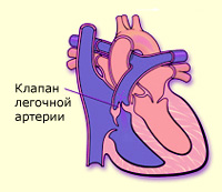 Изолированный клапанный стеноз легочной артерии1
