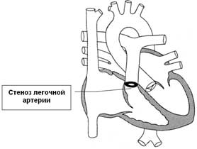 Периферический стеноз легочной артерии1