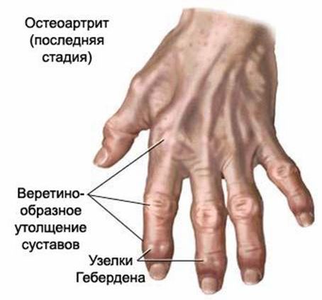 Артрит пальцев рук: симптомы, лечение