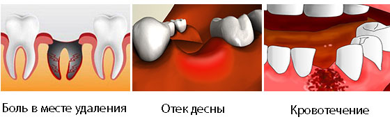 Осложнения после удаления зуба1
