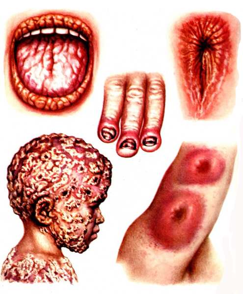 Кандидоз полости рта: симптомы, лечение1