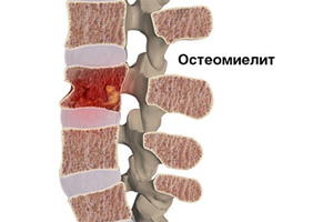 Остеомиелит: причины, симптомы, лечение1